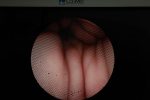 Riester 3900 Nasofaryngoskop Fiberoskop Endoskop