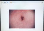 Wideodermatoskop FotoFinder Dermoscope 500 + Drukarka HP D4360